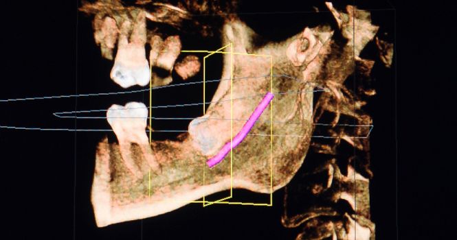 horizontal verlagerter Weisheitszahn und Darstellung des Nervus alveolaris inferior mittels digitaler 3D-Röntgenaufnahme